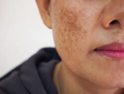 Mengenal Penyakit Xeroderma Pigmentosum dari Serial  A Shop For Killers