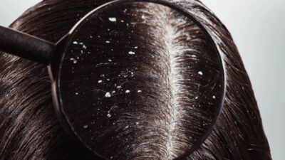 Atasi Ketombe, Kenali 6 Penyebab dan Cara Mengatasinya!