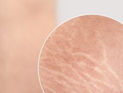 Stretch Mark : Penyebab, Pencegahan, dan Penanganannya