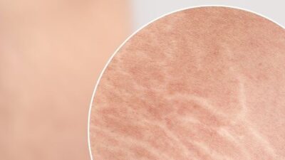 Stretch Mark : Penyebab, Pencegahan, dan Penanganannya
