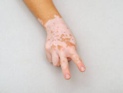 Apa Itu Vitiligo? Kenali Penyebab dan Pengobatannya